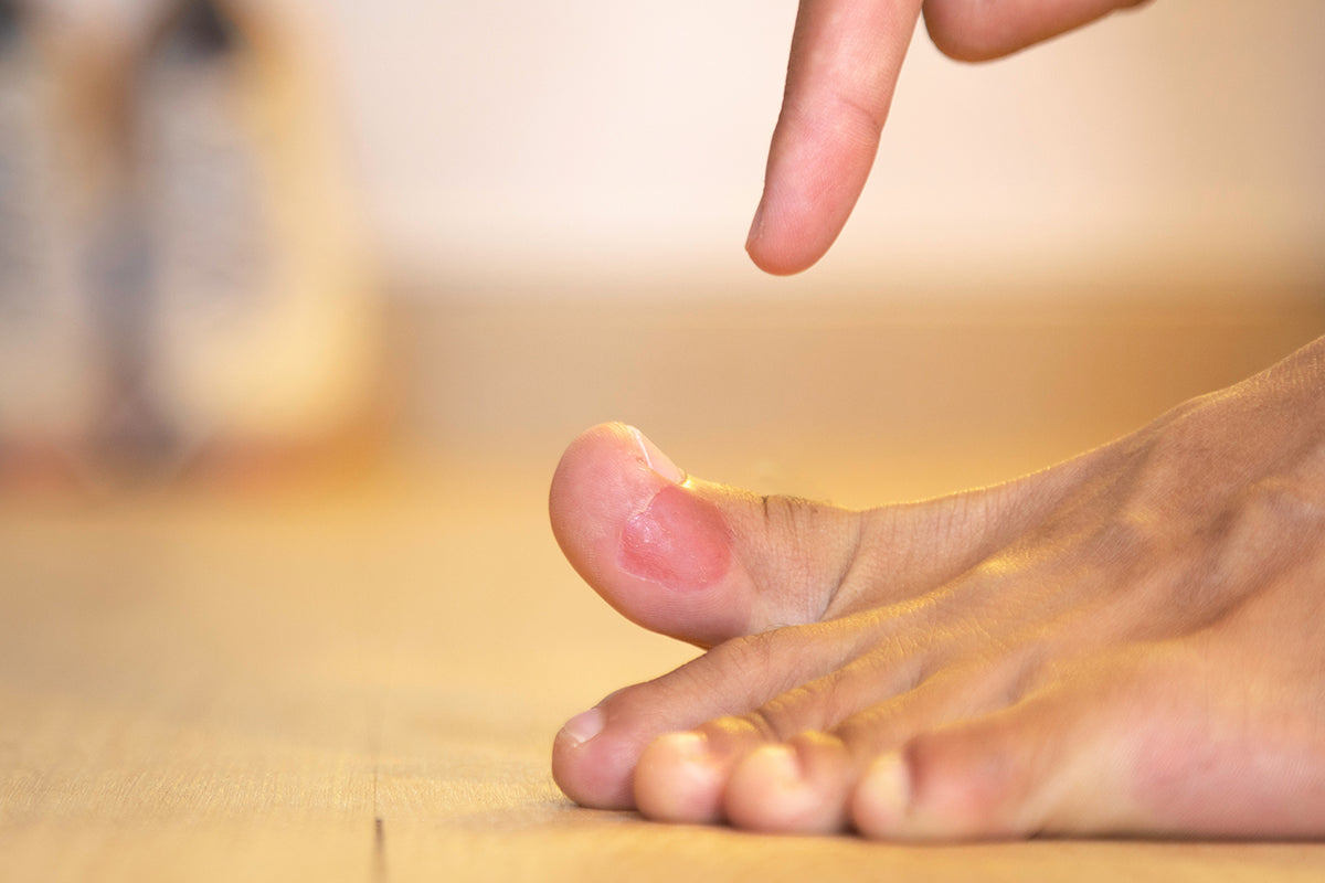 Blase auf dem Zeh verhindern