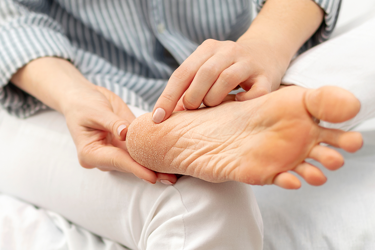 Schützt dicke Hornhaut vor Blasen?