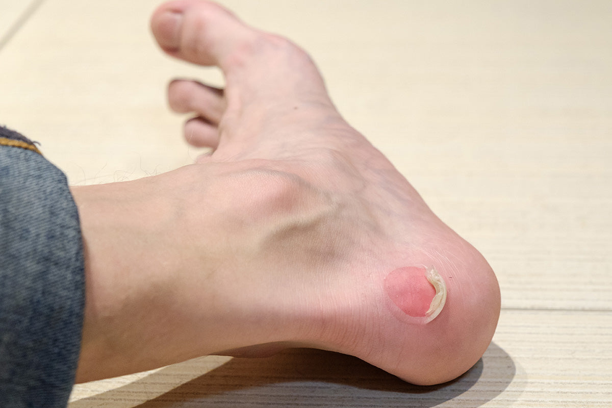 Blase am Fuß: Was tun? Behandlung, Tipps & Vorbeugung