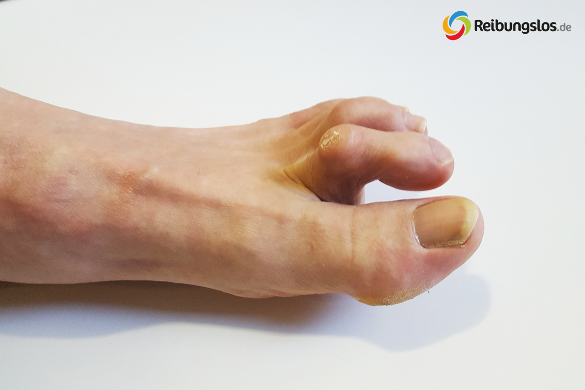 Blasen durch Hammerzeh (Digitus malleus) – Tipps & Hilfsmittel