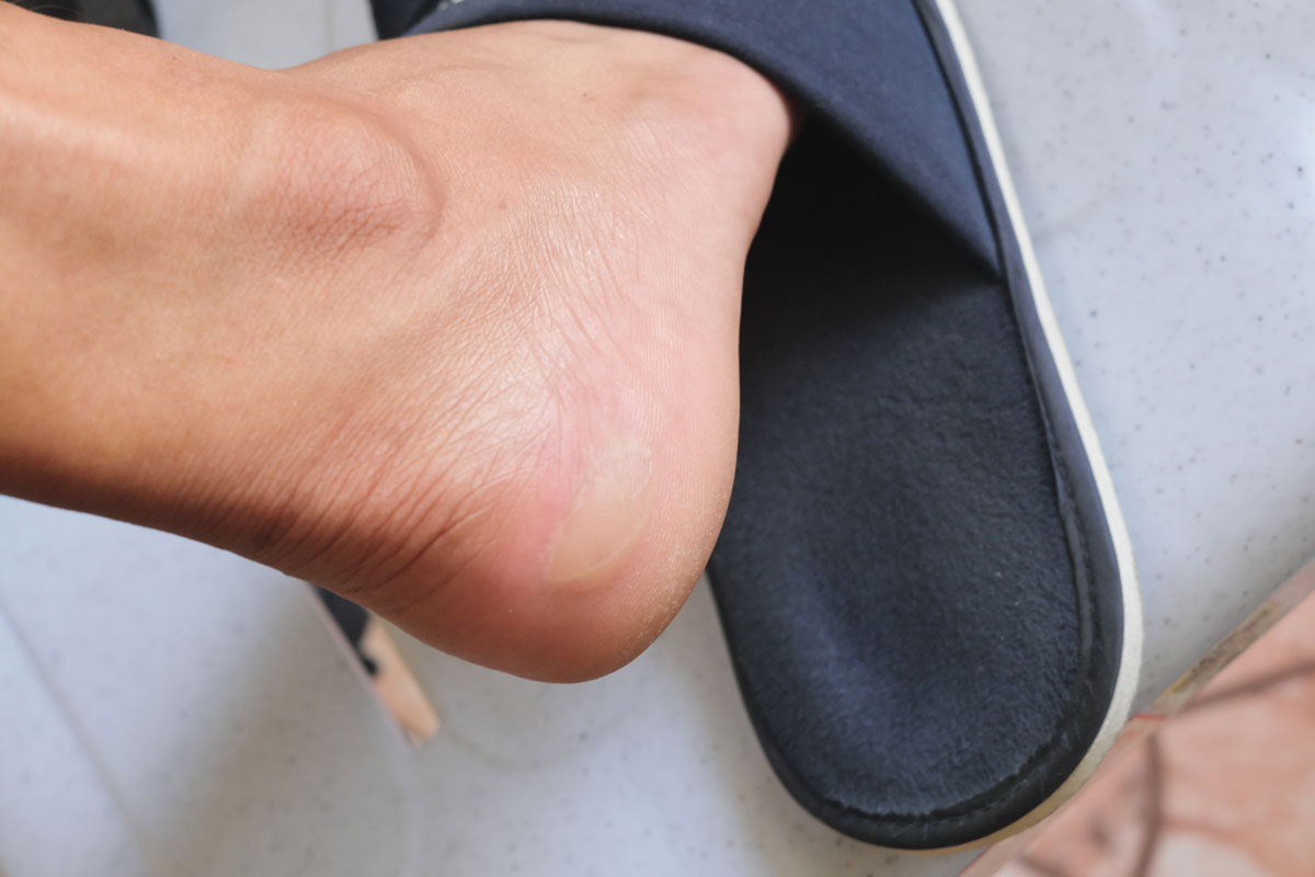 Blase an der Fersenkante verhindern