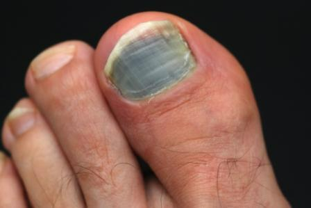 Blau-schwarz verfärbter Zehennagel am großen Zeh nach wiederholtem Anstoßen im Schuh